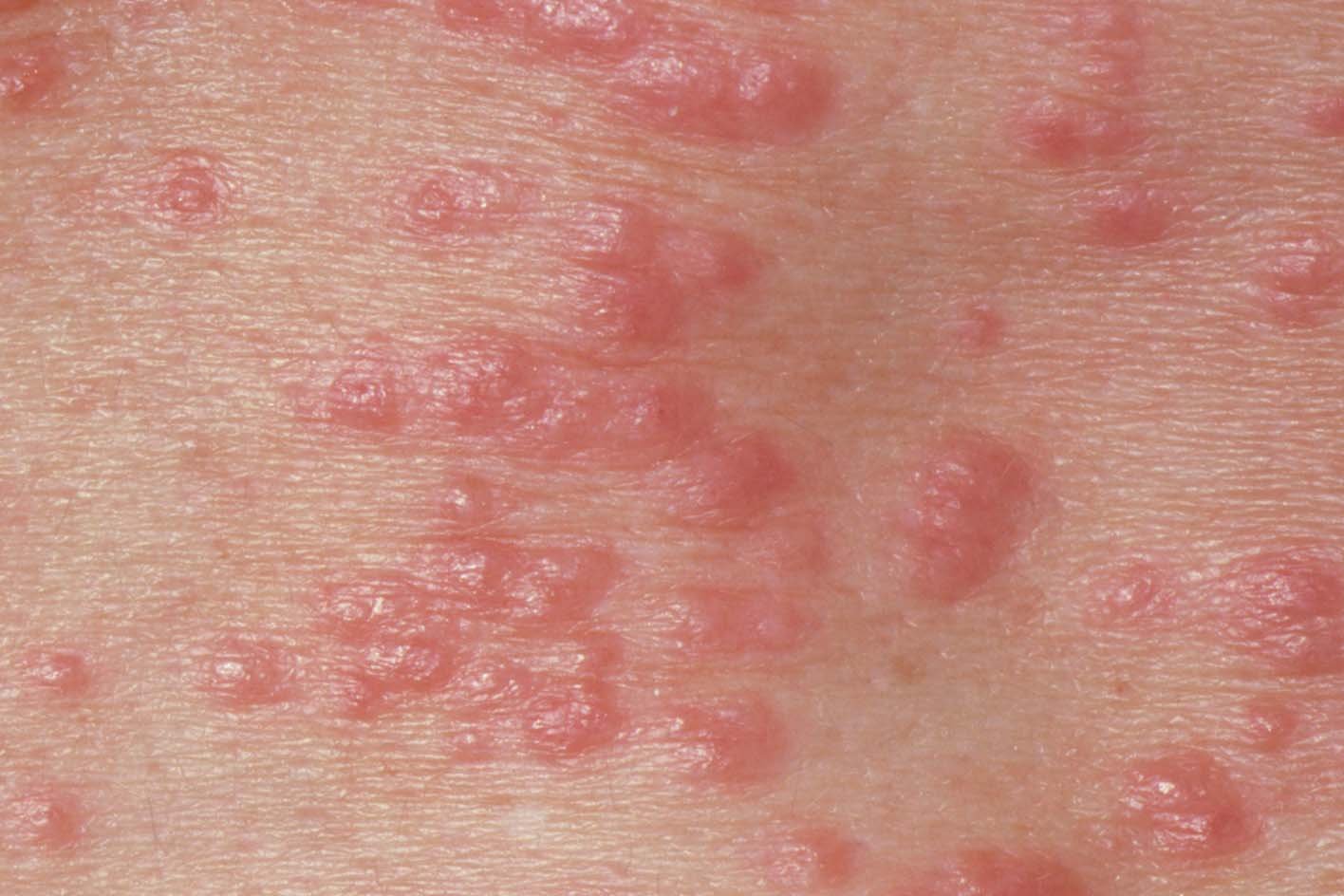 Scabies in malay